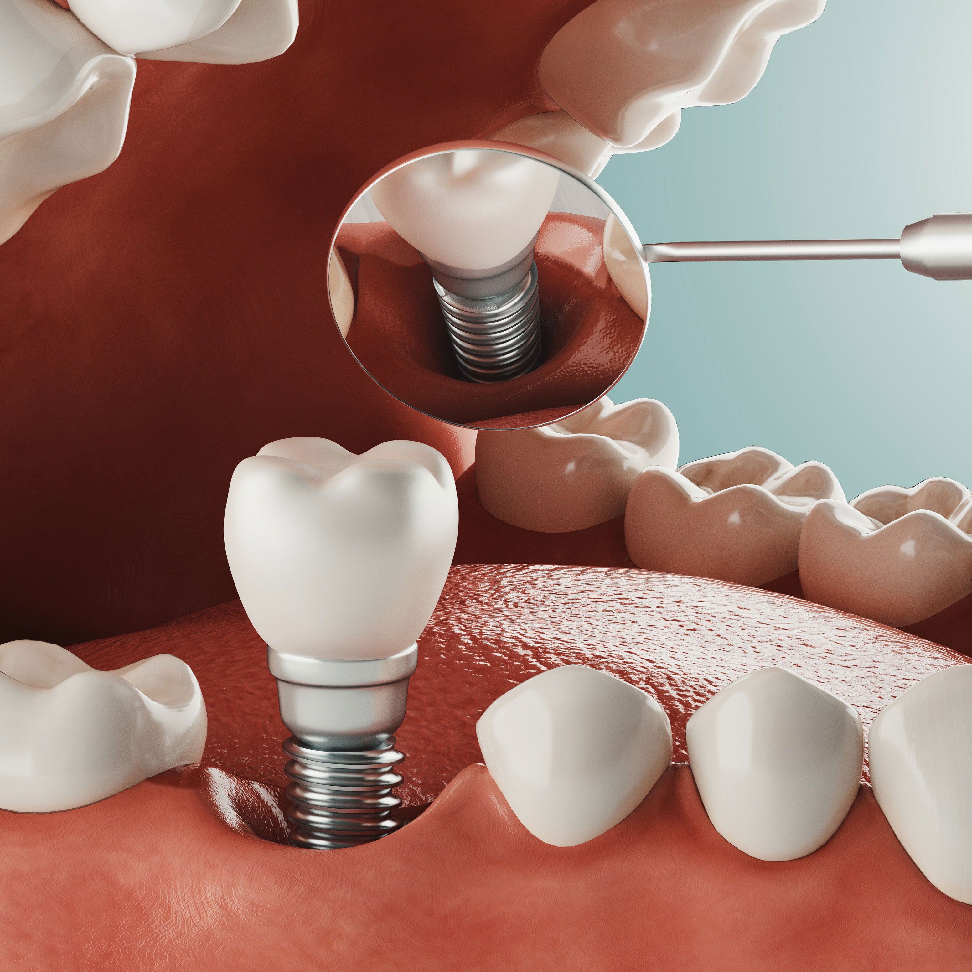 Close up of dental implant